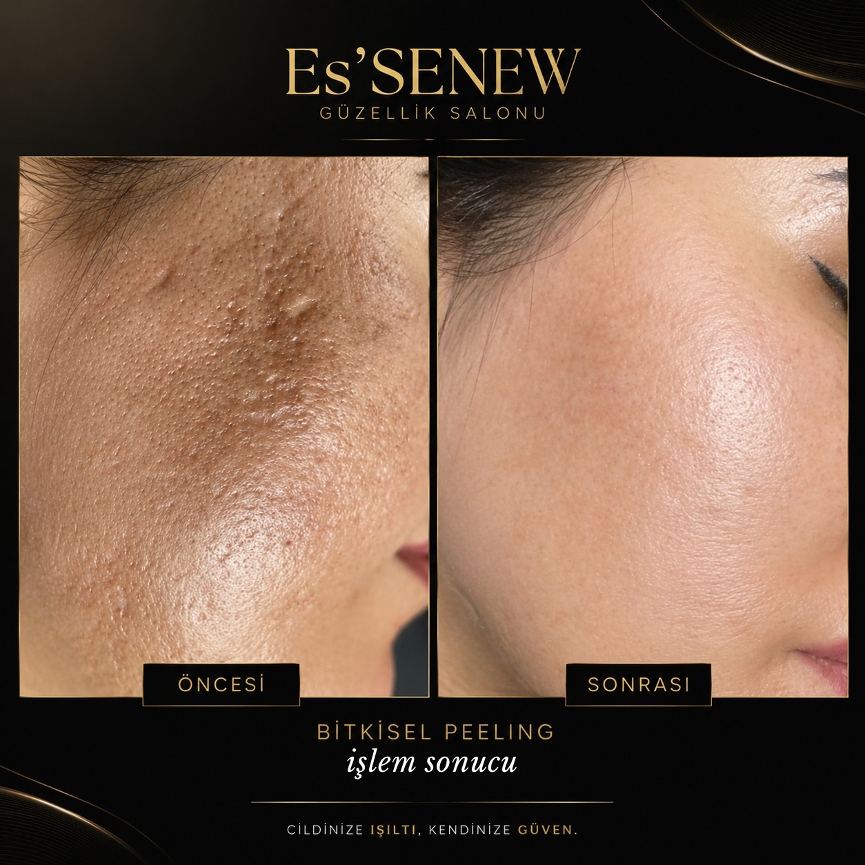 Bitkisel peeling öncesi ve sonrası
